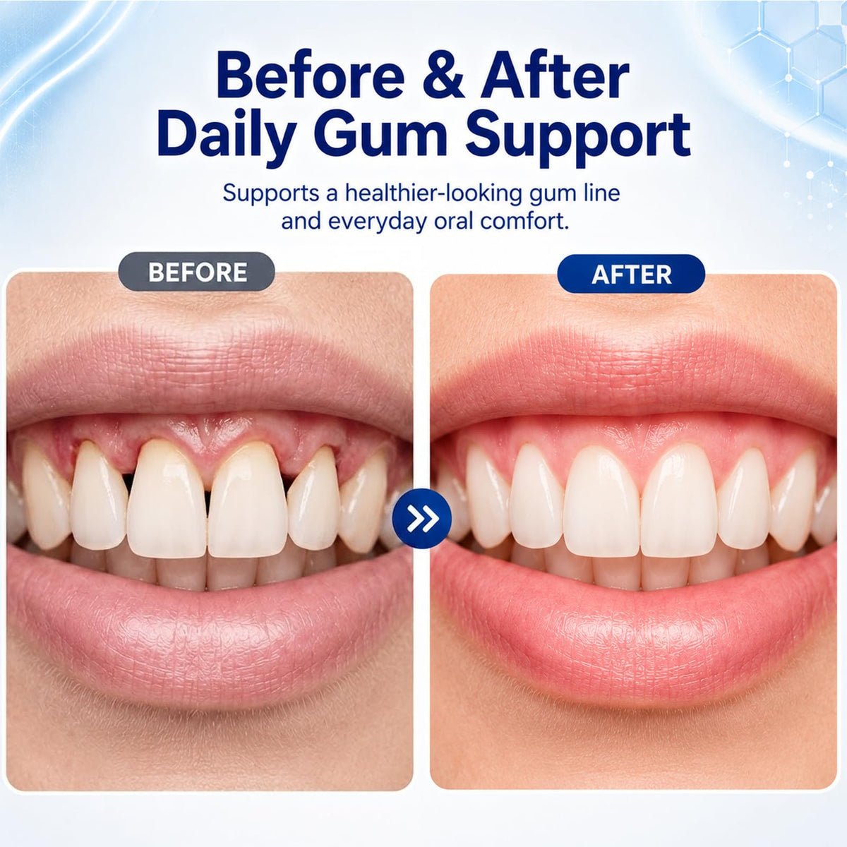 Bouteille de Nurevion Gum Restore ouverte montrant les capsules