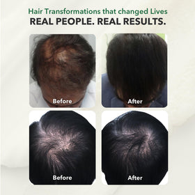 HairSmart DHT Blocker capsules avec des plantes
