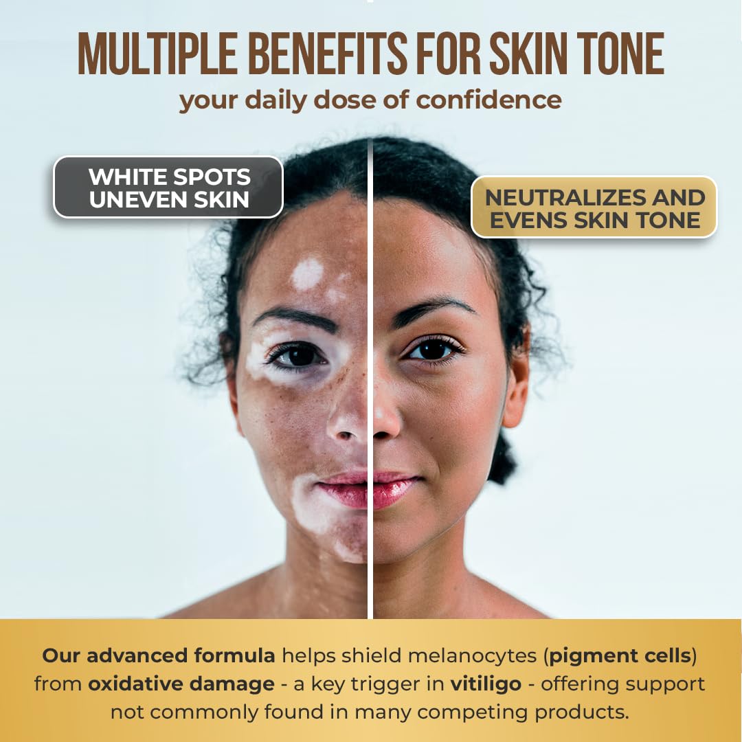 Prise de capsules Vitiligo AURA VITAMINS avec un verre d'eau