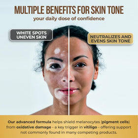 Prise de capsules Vitiligo AURA VITAMINS avec un verre d'eau